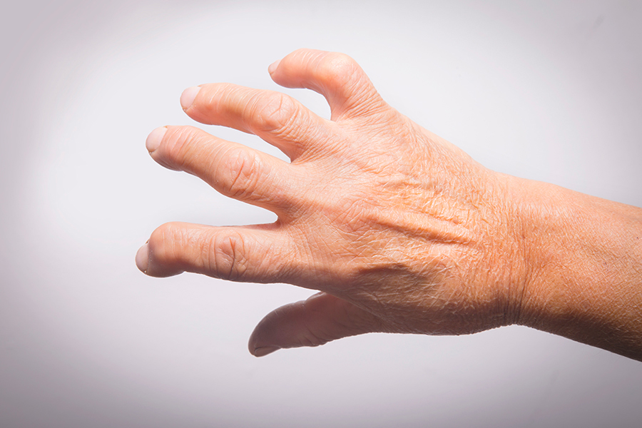 old arthritic hand